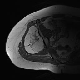 Liposarcoma Buttock MRI